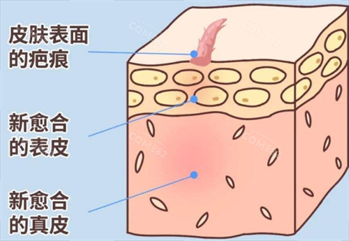 疤痕素材